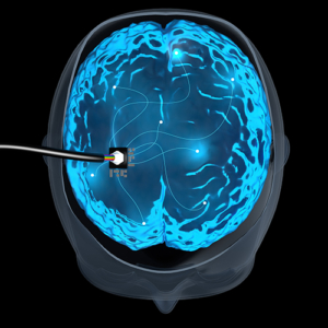 Electrode Implants May Now Be an Effective Stroke Treatment Option