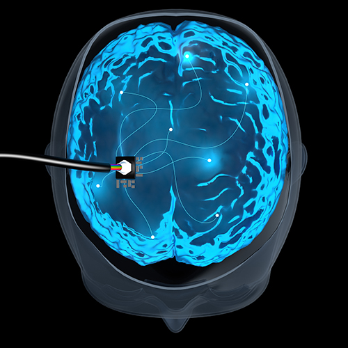 Electrode Implants May Now Be an Effective Stroke Treatment Option