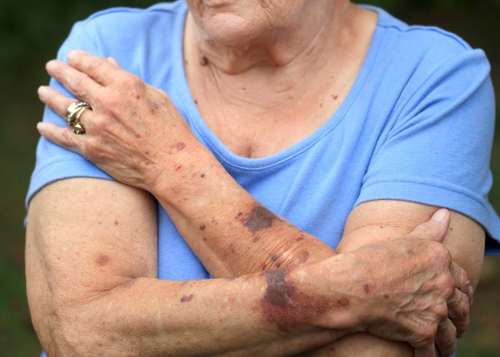 Bruise on an elderly person’s arm as a warning sign home care may be needed